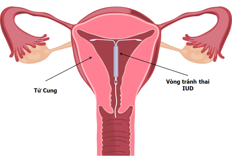 Đặt vòng tránh thai đạt hiệu quả cao và không ảnh hưởng đến khả năng sinh con sau này