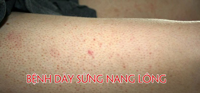 Phát ban đỏ trên da nhưng không ngứa là triệu chứng của bệnh dày sừng nang lông