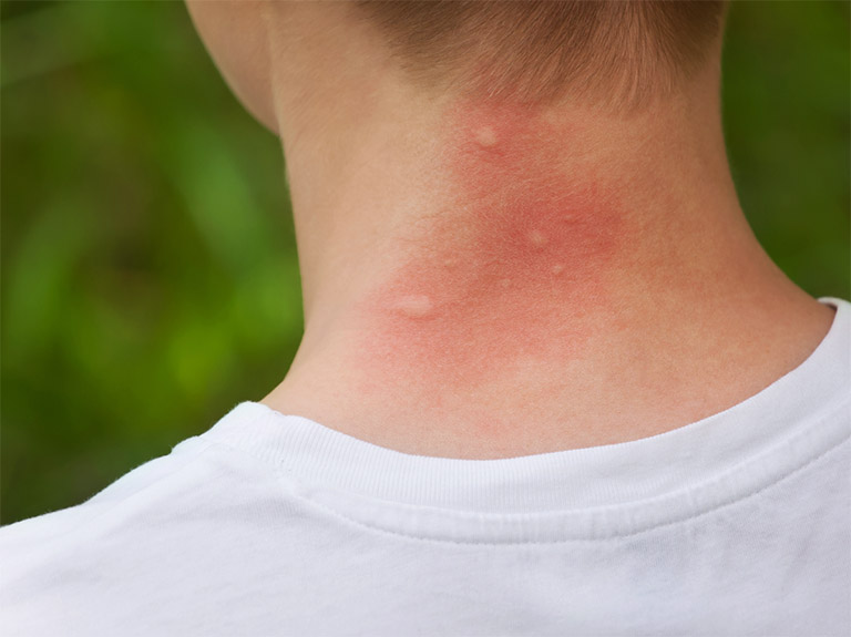 Hiện tượng nổi mẩn ngứa như muỗi đốt trên da có thể là một biểu hiện của một bệnh lý tiềm ẩn đang làm ảnh hưởng đến sức khỏe người mắc phải