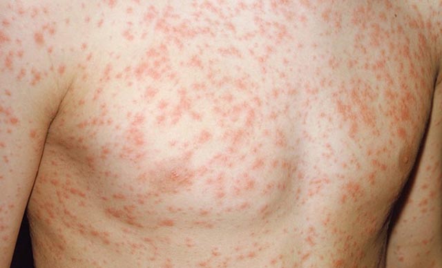 Nổi mẩn đỏ khắp người không sốt không ngứa là bệnh gì?