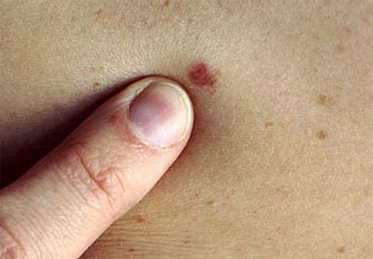 Xuất hiện nốt ruồi màu đỏ bất thường trên da là dấu hiệu của bệnh ung thư da nguy hiểm