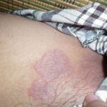 Hắc lào ở háng thumbai