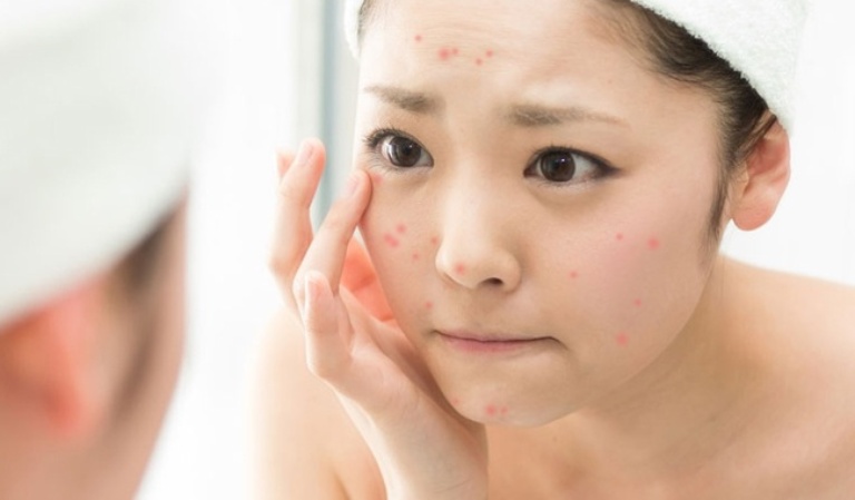 Khi dùng thuốc tránh thai khẩn cấp có thể gây ra các bệnh về da