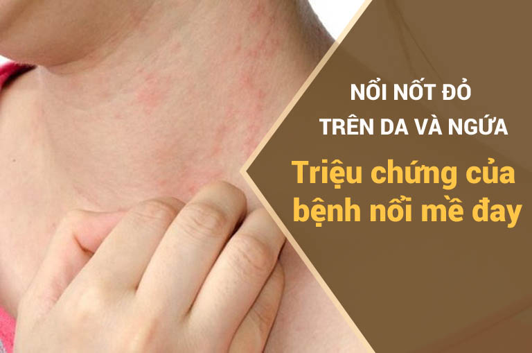 Nổi nốt đỏ trên da và ngứa có thể là dấu hiệu của bệnh mề đay