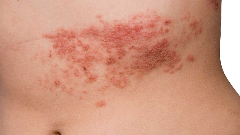 Tình trạng nổi các nốt đỏ trên da thường đi kèm với các triệu chứng ngứa ngáy khó chịu