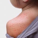 Nổi đốm đỏ trên da không ngứa thumbai