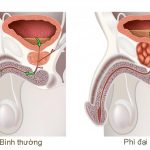 Phì đại tuyến tuyền liệt có thể gấp 5 lần so với thể tích bình thường