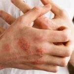 Bệnh viêm da cơ địa là gì ? Cách nhận biết và điều trị hiệu quả