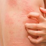 Bị nổi mề đay nên kiêng gì ?