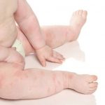 Chữa mề đay cho trẻ sơ sinh dưới 1 tuổi cần hết sức lưu ý