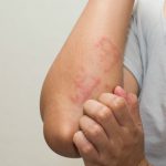 Người bị nhiễm giun sán lạc chủ sẽ gặp phải tình trạng nổi mề đay lâu ngày không khỏi.