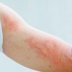 Nổi mề đay nhưng không ngứa là dấu hiệu cảnh báo nhiều bệnh lý