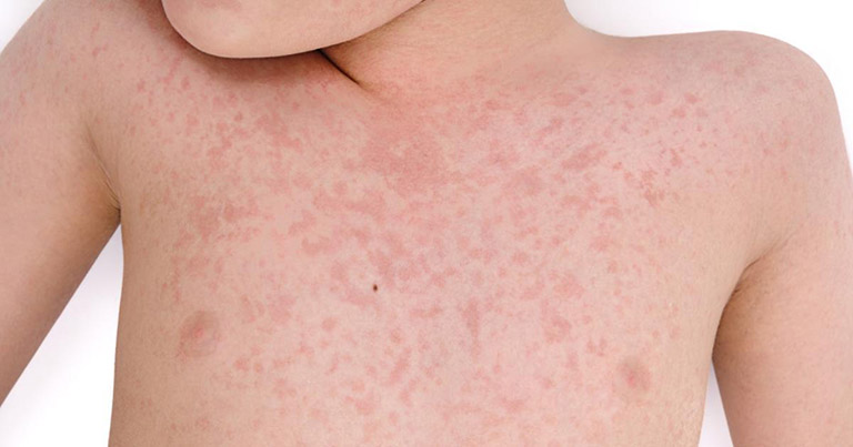 Nổi mề đay ở trẻ em Nổi mề đay ở trẻ em