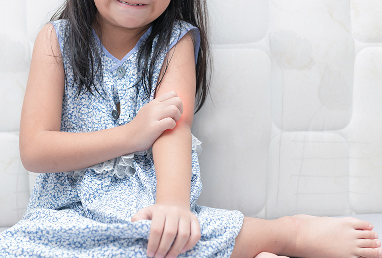 Nổi mề đay ở trẻ em Nổi mề đay ở trẻ em