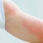 Các loại sữa tắm an toàn cho người bị viêm da cơ địa