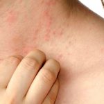 Nổi mề đay gây ra tình trạng ngứa ngáy khó chịu.