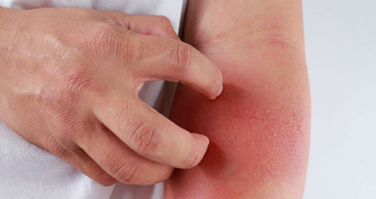 Người bệnh viêm da cơ địa thường hay có thói quen gãi nhiều, cọ gãi mạnh, khiến da bị trầy xước, nhiễm trùng.