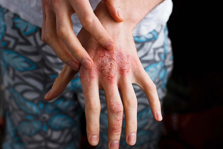 bệnh chàm eczema ngoài da