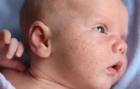 Chàm sữa ở trẻ sơ sinh và các thông tin cần biết