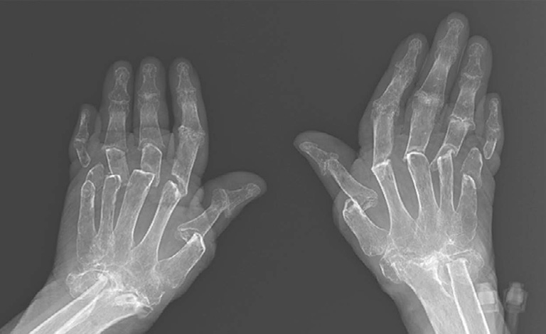Chụp X- quang giúp phát hiện và xác định được mức độ bệnh lý mà bệnh nhân đang mắc phải 