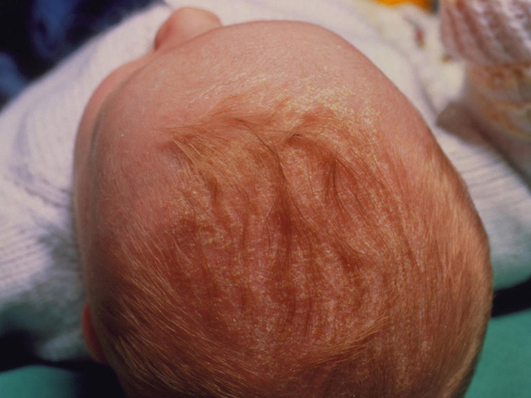 chàm da đầu ở trẻ sơ sinh