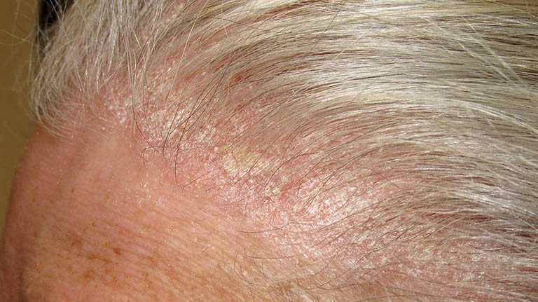 Nguyên nhân gây ra bệnh vảy nến da đầu nhẹ