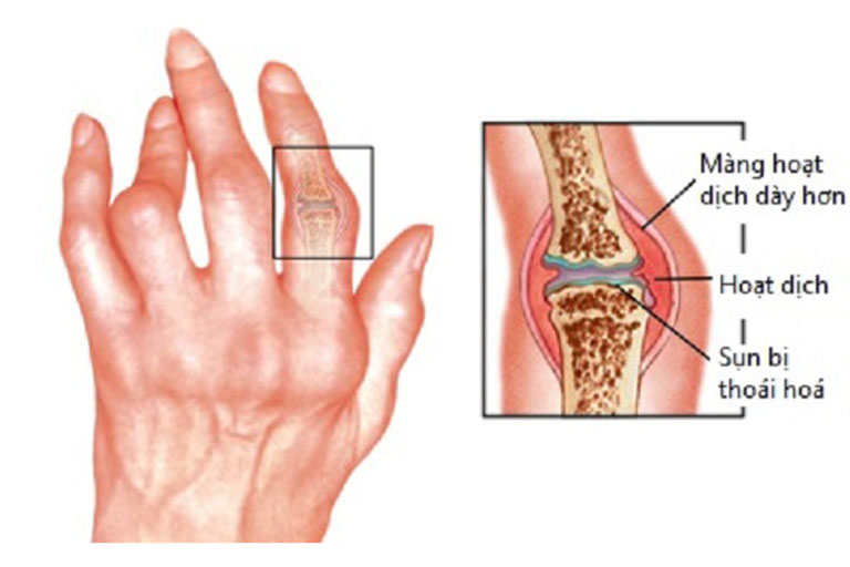 Biến dạng ngón tay là một trong những biểu hiện của bệnh.