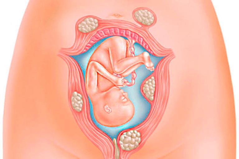 U xơ tử cung khi mang thai