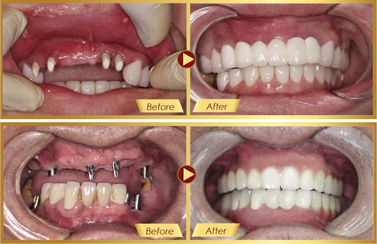 Cấy răng implant TPHCM nha khoa ident
