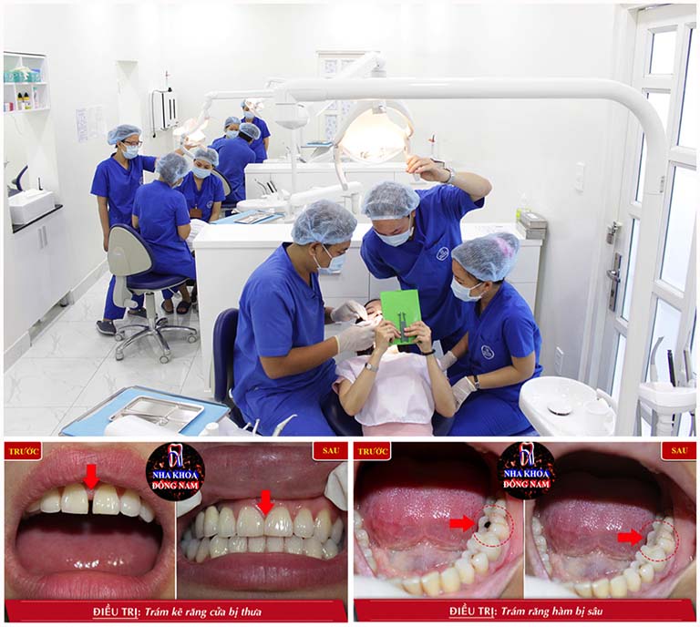 Trám răng nha khoa Đông Nam tại TPHCM
