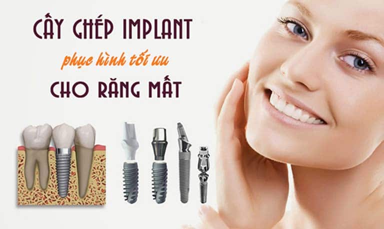 Cấy ghép Implant là gì? Ưu và nhược điểm khi cấy ghép Implant