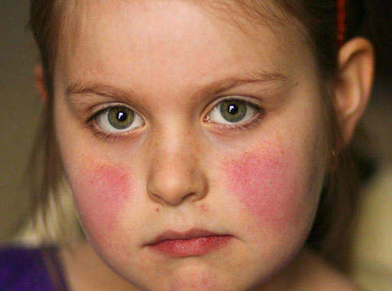 Đau khớp gối ở trẻ em cảnh báo bệnh gì