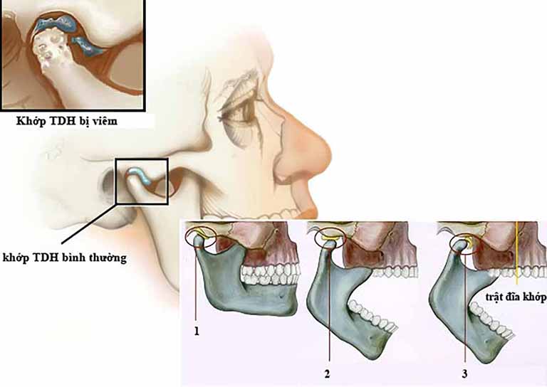 Trật khớp hàm thái dương là một trong những biến chứng viêm khớp hàm thái dương thường gặp