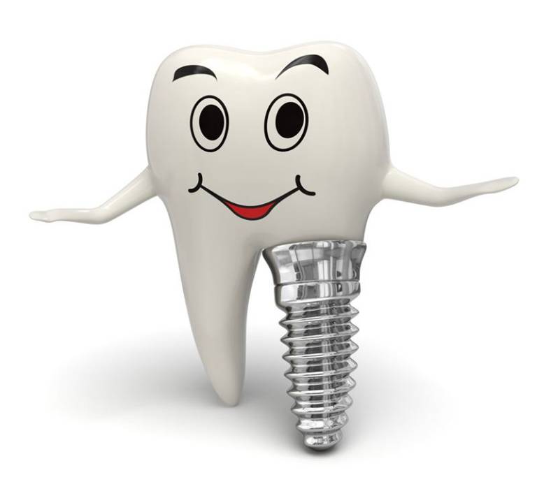 Để răng khỏe mạnh, chóng hồi phục chế độ chăm sóc sau trồng răng Implant đóng vai trò vô cùng quan trọng