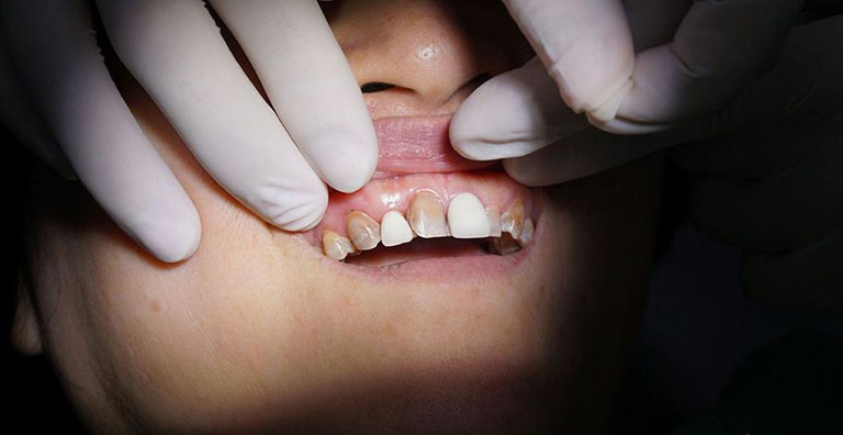 Nên lựa chọn những cơ sở nha khoa uy tín để dán răng sứ Veneer 