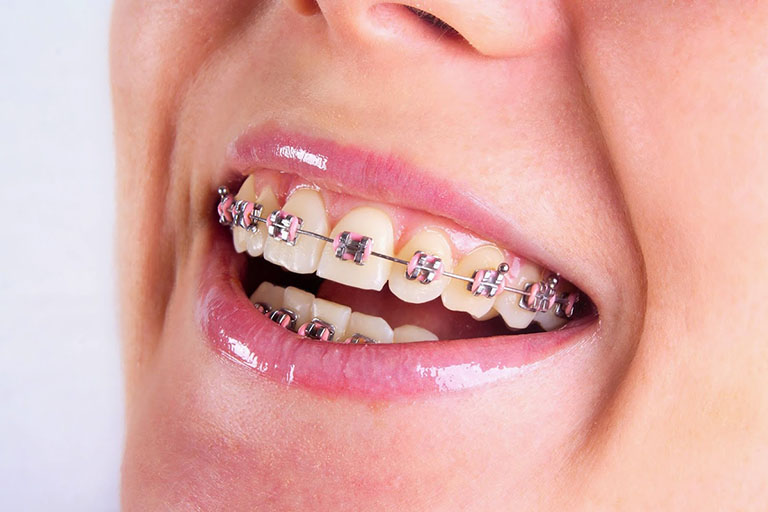 niềng răng mắc cài kim loại có ưu điểm gì