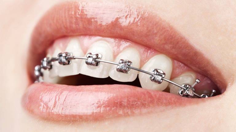 Niềng răng mắc cài tư buộc có hệ thống thanh trượt đặc biệt giúp giảm ma sát ít gây đau cho người đeo mắc cài