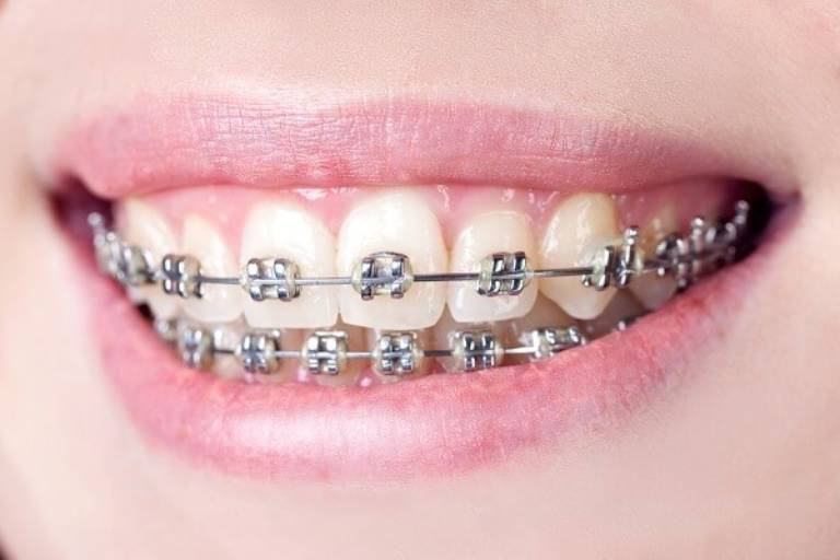 Niềng răng mắc cài kim loại tự buộc sử dụng hệ thống rãnh trượt từ hợp kim niken và titan