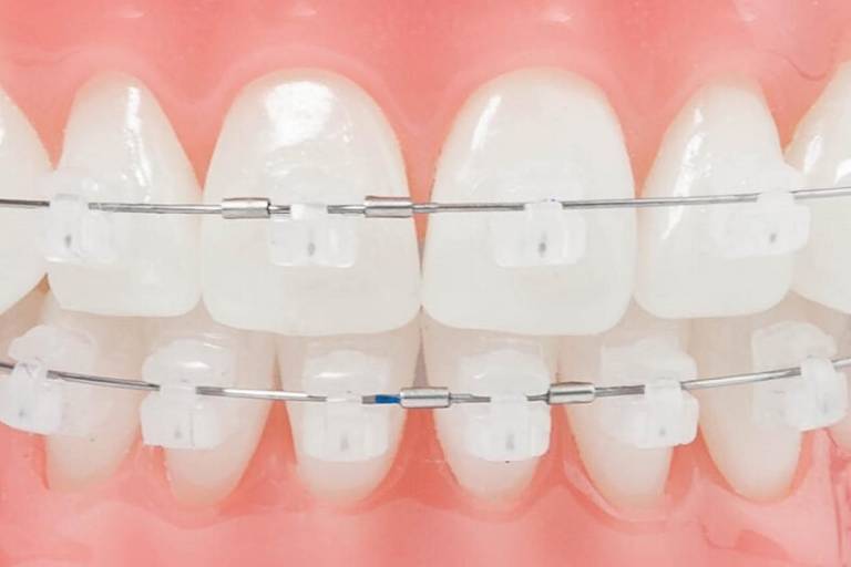 Phương pháp niềng răng bằng mắc cài tự buộc cần được thực hiện đúng quy trình