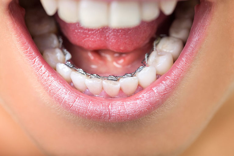 Niềng răng một hàm có hiệu quả không?