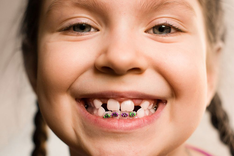 Liệu niềng răng một hàm có hiệu quả không?