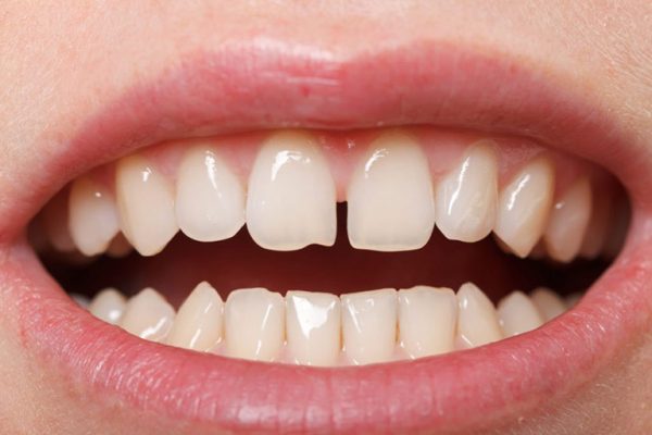 Niềng răng một hàm có hiệu quả không?