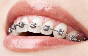 Phương pháp niềng răng phổ biến