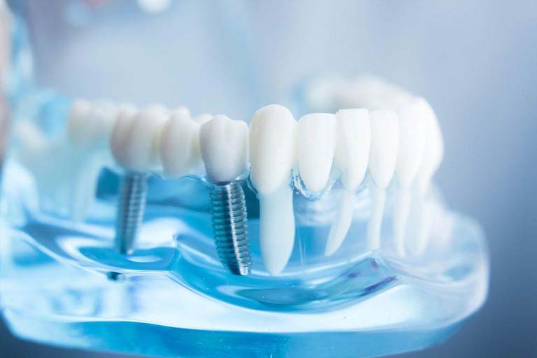 Răng implant có bền không? Sử dụng được bao lâu?