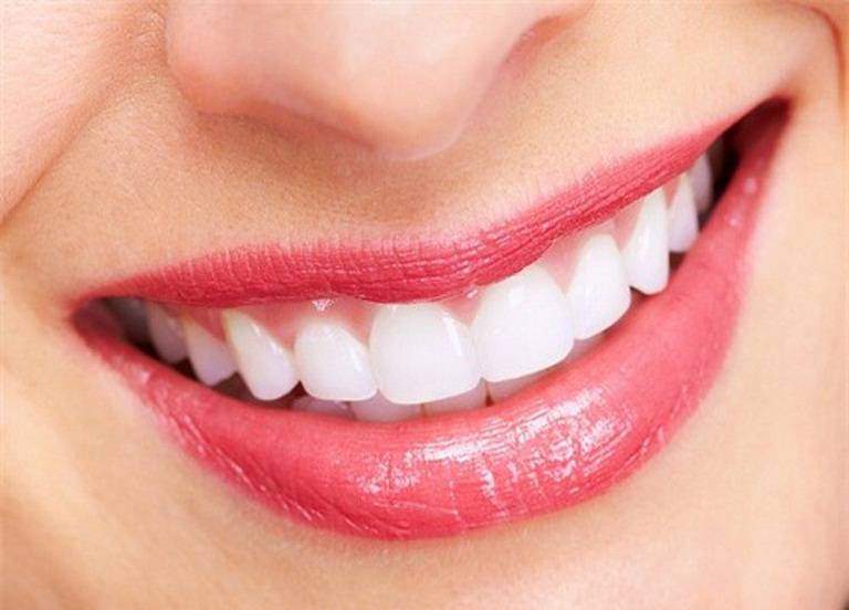 Thời gian niềng răng mất bao lâu để răng đều và đẹp