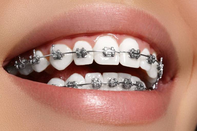Thời gian niềng răng mất bao lâu để răng đều và đẹp