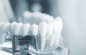 Trồng răng Implant loại nào tốt, phổ biến nhất hiện nay là thắc mắc chung của nhiều người
