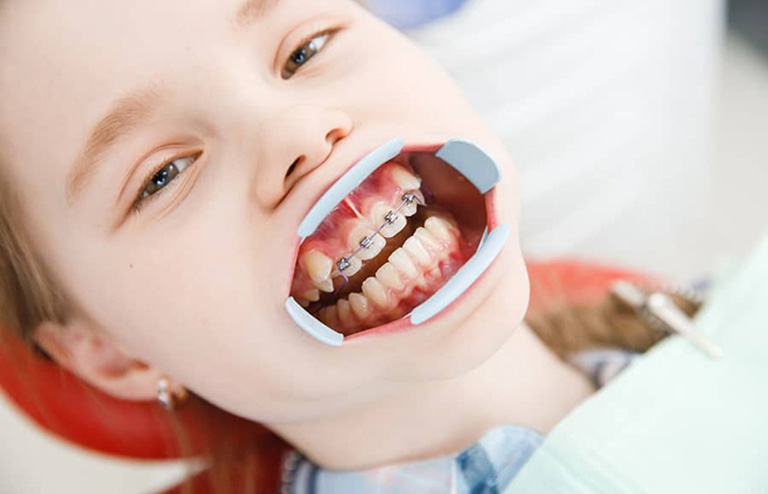 Trường hợp nào nên tiến hành niềng răng cho trẻ