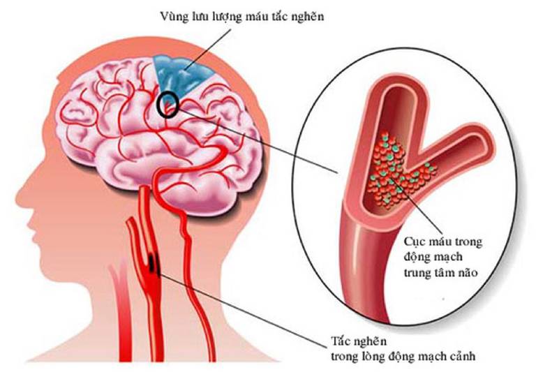 Thiểu năng tuần hoàn não là do tắc nghẽn cục máu đông ở động mạch gây thiếu máu lên não