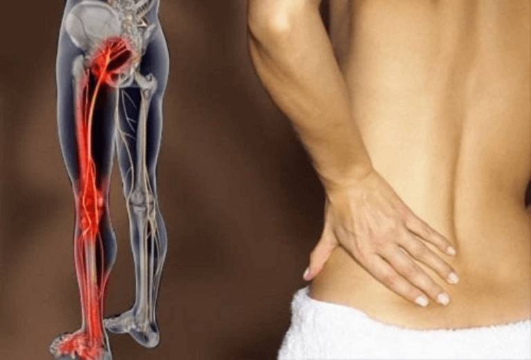 Đau nhức vùng mông xuống bắp chân thường liên quan đến các bệnh lý về dây thần kinh tọa và xương khớp